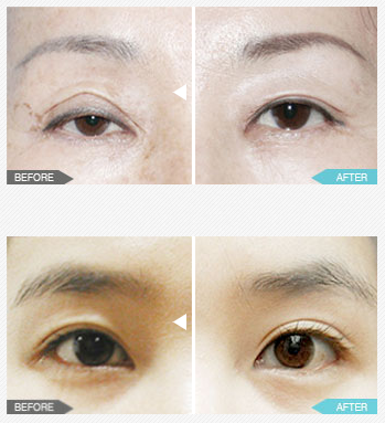 korean eye surgery before after