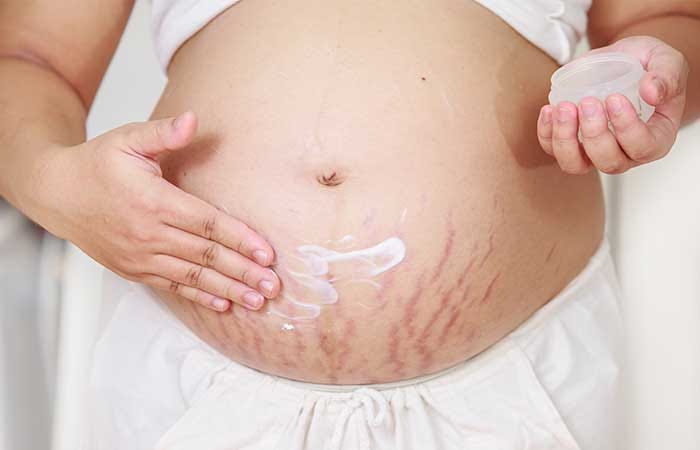 topical cream for white stretch marks