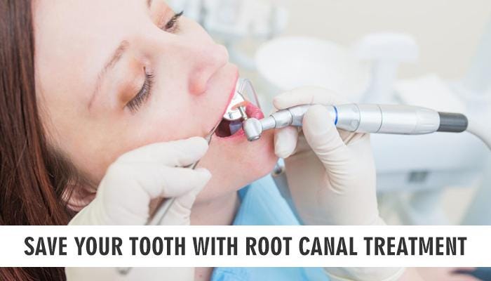 Save your tooth with root canal treatment | by Smiles DentalSpa | Medium