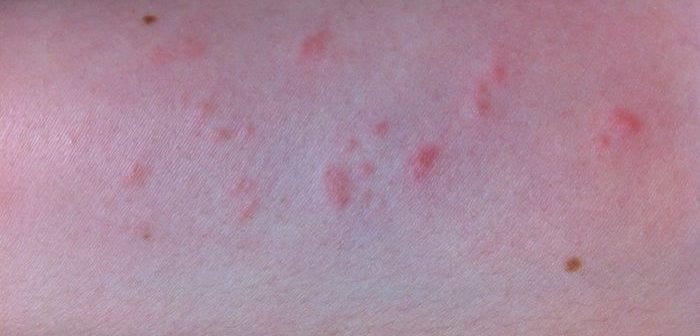 Small Red Itchy Bumps On Arms