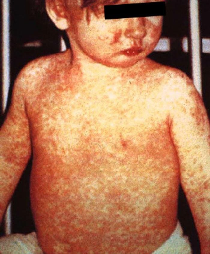 To Vaccinate or Not to Vaccinate The why’s, the whynot’s, and where