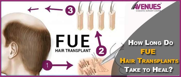 How Long Do Fue Hair Transplants Take To Heal Avenues Clinic