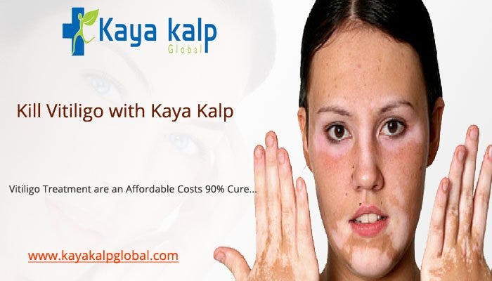 best vitiligo treatment in world