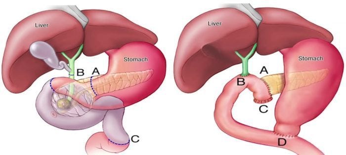 The Anatomy Of A Whipple Procedure By Let s Win Pancreatic Cancer 