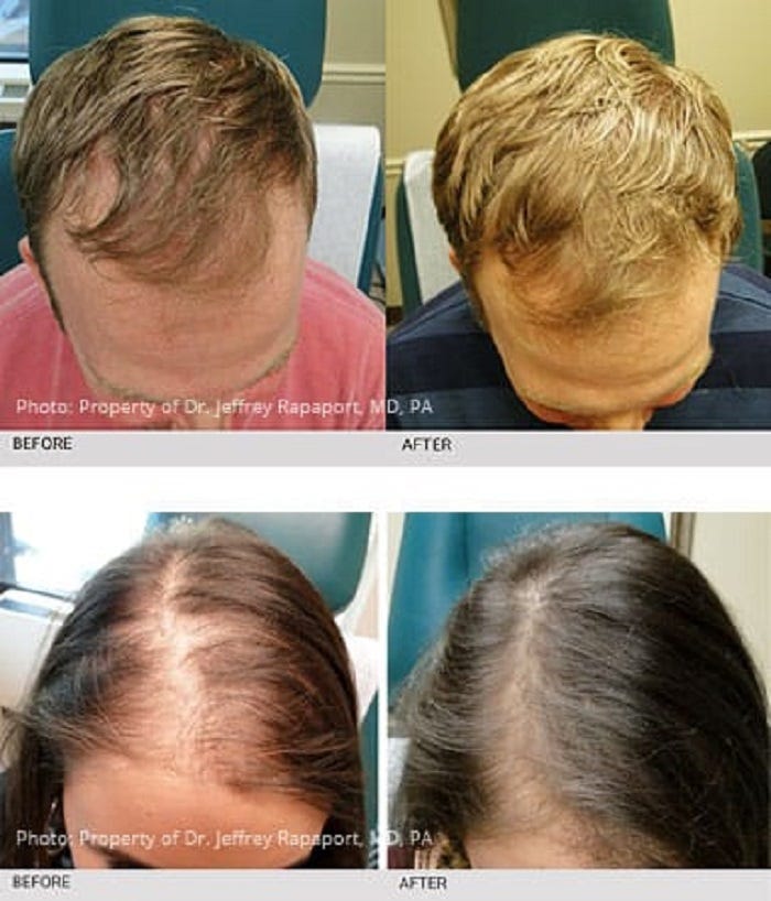 Platelet Rich Plasma Prp Hair Loss Therapy In Minneapolis