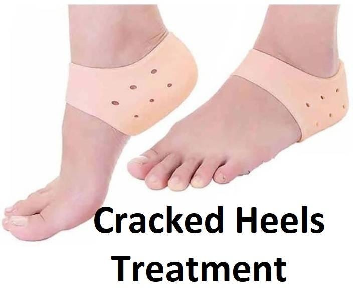 keratolytic for cracked heels