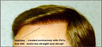 Principles Techniques Used To Create A Natural Hairline In