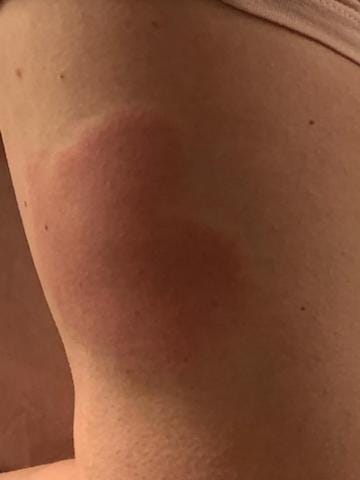 Covid Arm Rash After The Moderna Shot Is Common But Not Worrisome By Tara Haelle Medium Coronavirus Blog