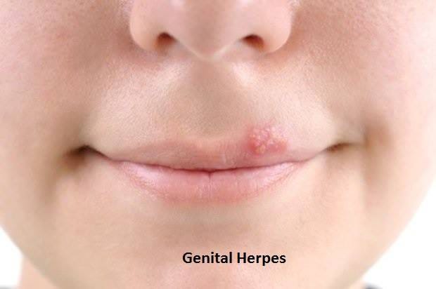 Signs Symptoms And Causes Of Herpes Simplex Louis Carlo Lim Medium