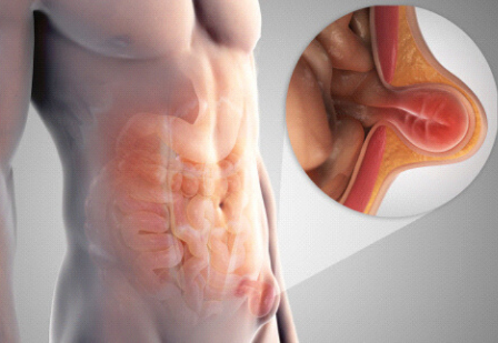 Is It Possible For Your Hernia To Go Away Without Surgery?