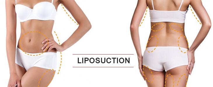 Taking a Step Towards Liposuction