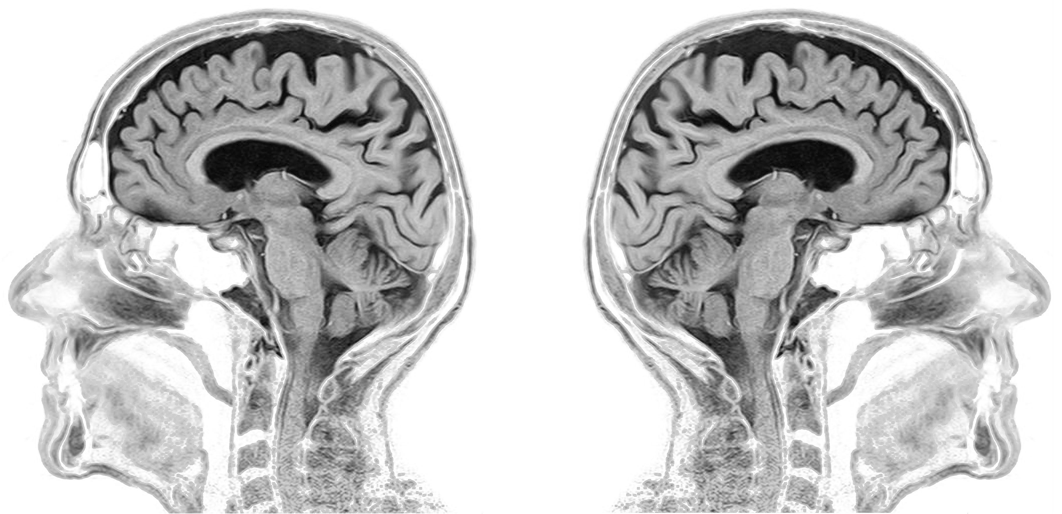Intro to Analyzing Brain Imaging Data — Part III: The ...