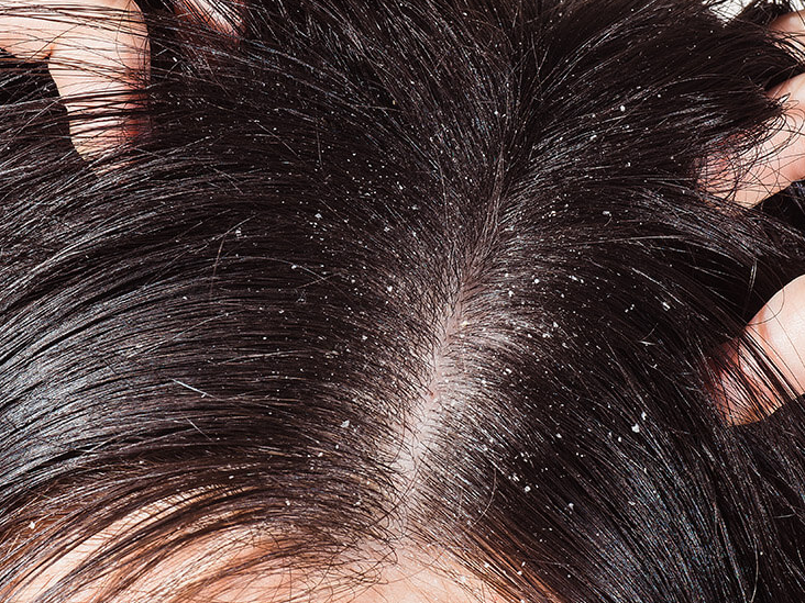 Home Remedies To Get Rid Of Dandruff Problems How To Cure Dandruff