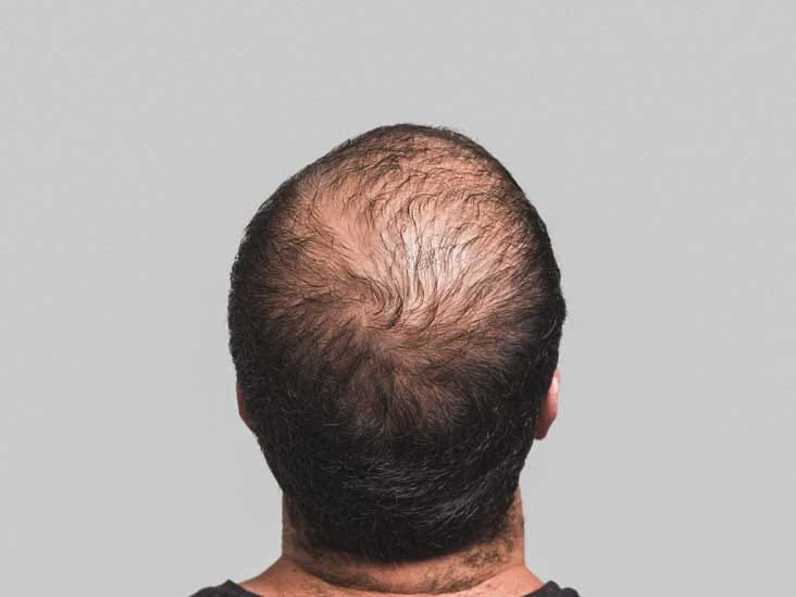 How Can I Recover After Hair Transplant Hair Surgery Medium