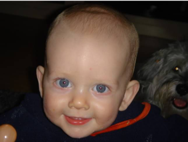 So Your Child Has A Metopic Ridge By Jesse Goldstein Medium So Your Child Has A Metopic Ridge By Jesse Goldstein Medium