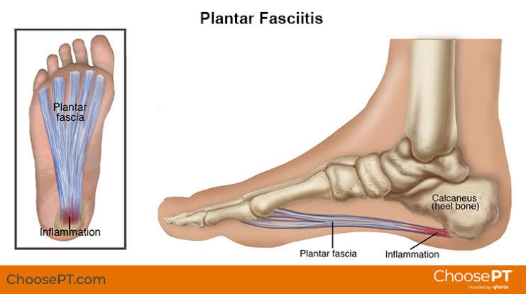 Plantillas fascitis plantar mujer