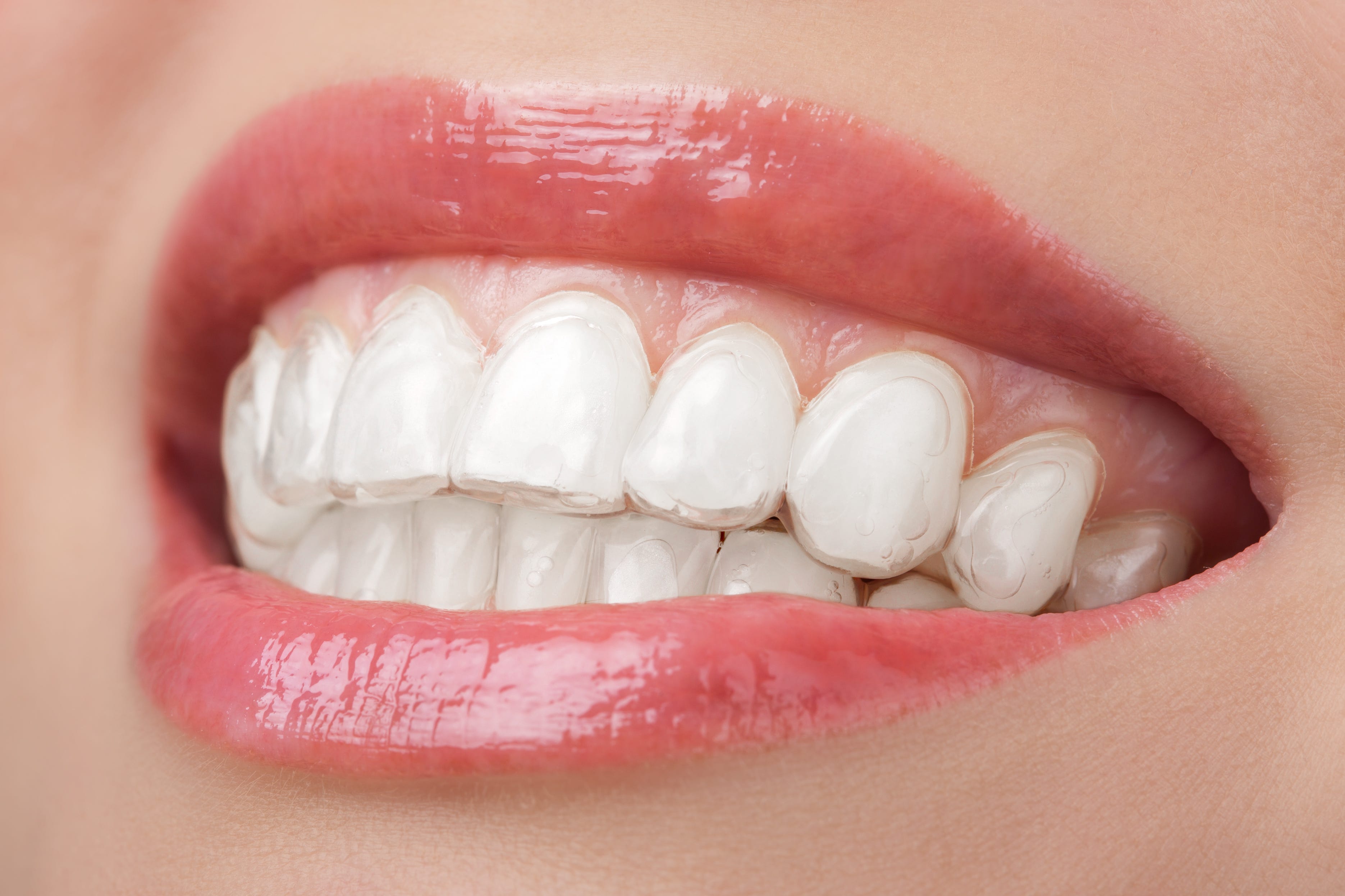 Appareil dentaire invisible : comment prendre soin de mes aligneurs  dentaires transparents ? | by Orthlane | Medium