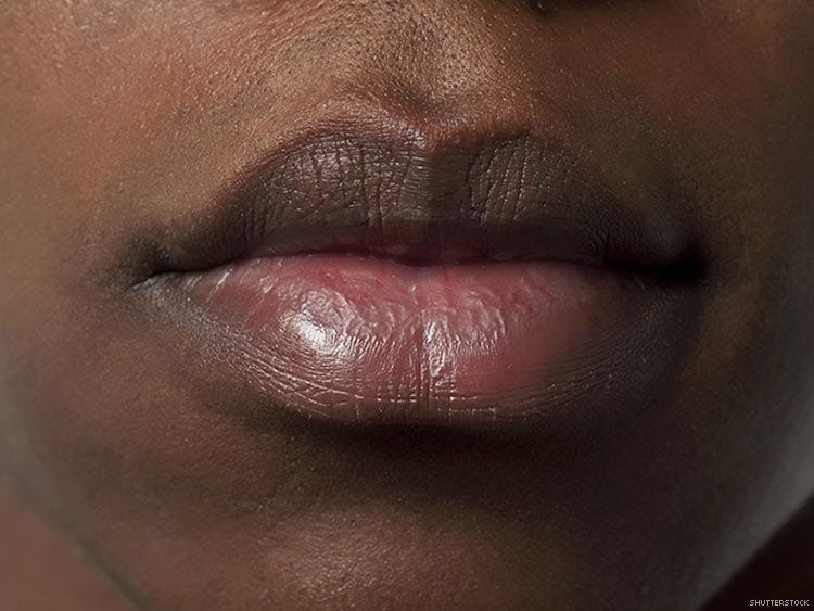 Why Is My Upper Lip So Dark One Of The Side Effects Of Sun Damage why-is-my-upper-lip-so-dark-one-of-the-side-effects-of-sun-damage
