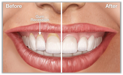 How To Reverse Receding Gums From Getting Worse? | by consumerhealth