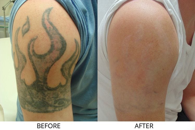 Laser Tattoo Removal. Research has shown that nearly half of… | by Stephen  Cagnassola | Medium