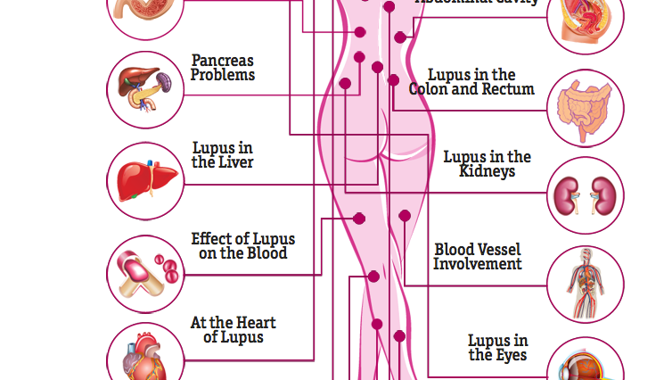 The Effects Of Lupus On The Human Body Ashley Qualls Medium