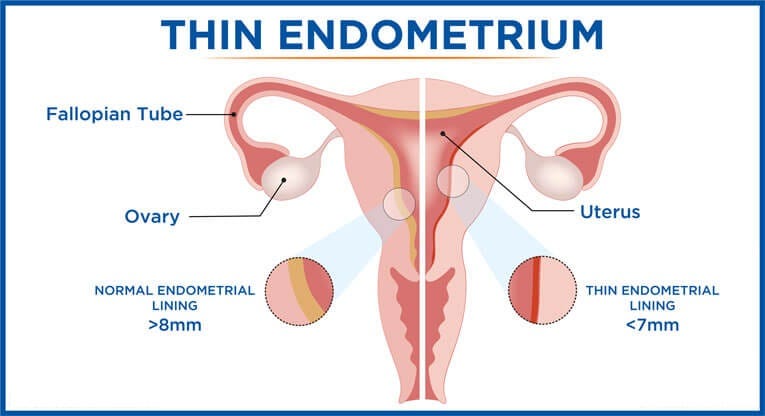 Endometrium Pregnancy A Hormone Called Estrogen Plays An By Dr Aarti Parakh Medium