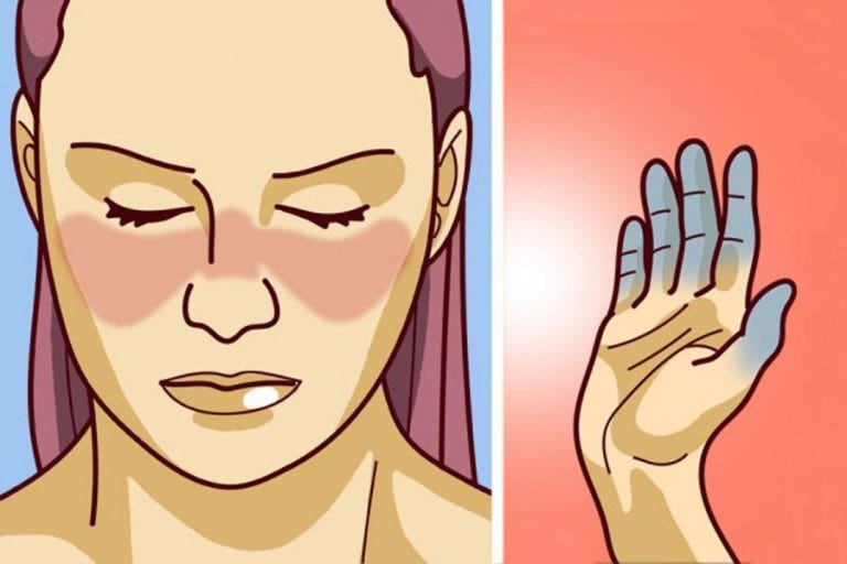 Lupus 8 Interesting Facts To Know About This Disease By Maria Sanchez Medium