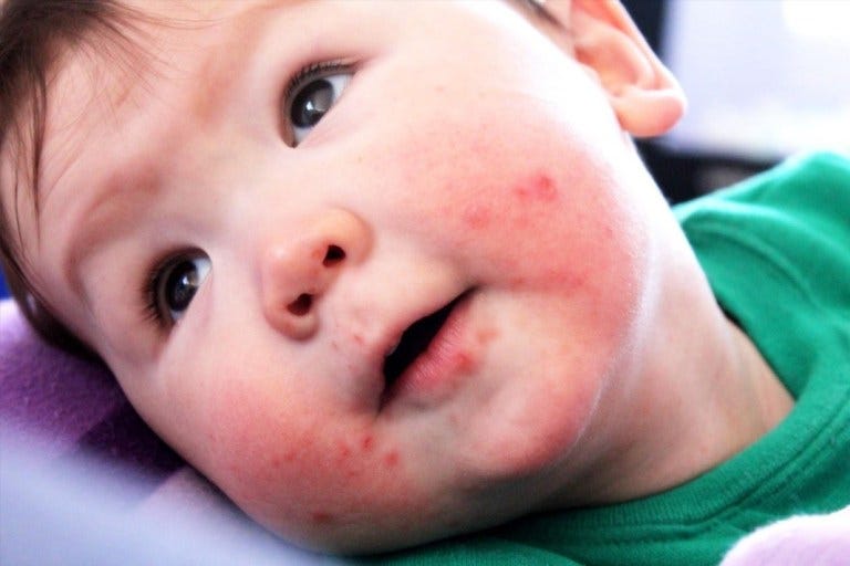 Tips To Cure Pacifier Rash Teething Rash By Roxanna Hall Medium