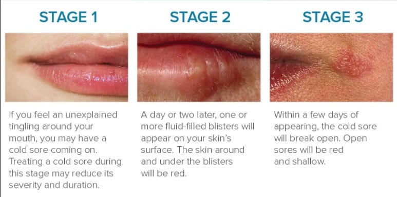 What to take to prevent cold sores