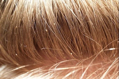 Major Reason Why Lice Keeps Coming Back Lice Removal Challenges By Osmotherapeutics Inc Medium