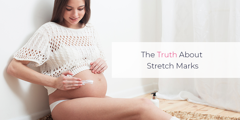 hydrocortisone stretch marks