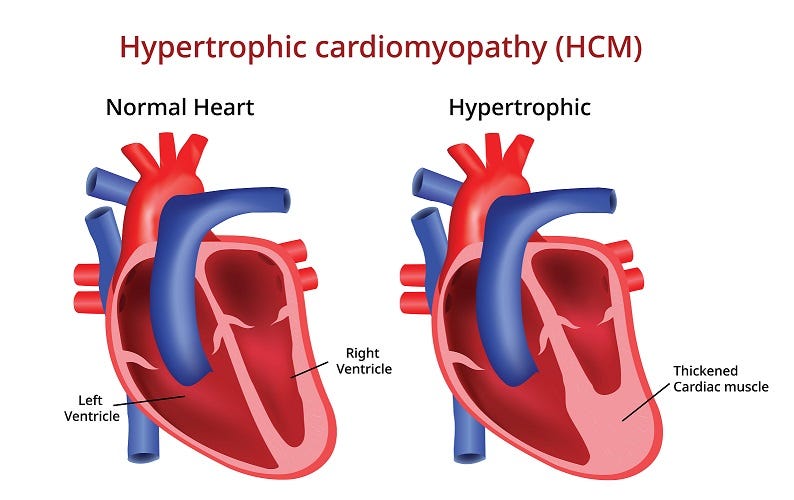 Hypertrophic cardiomyopathy in children