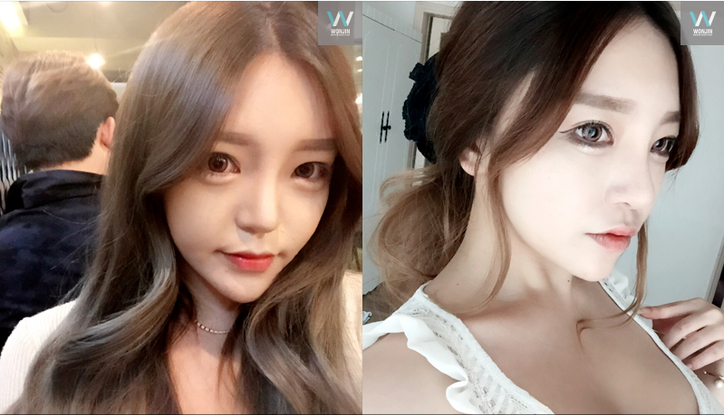 korean eye plastic surgery