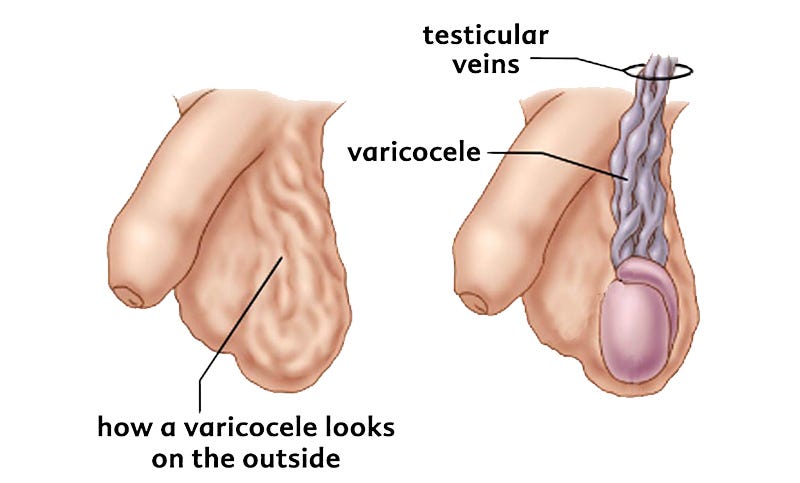 Consultarea medicilor varicoz. De la capsule de varicoză a