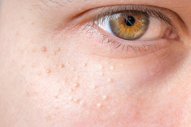 skin care routine for milia prone skin