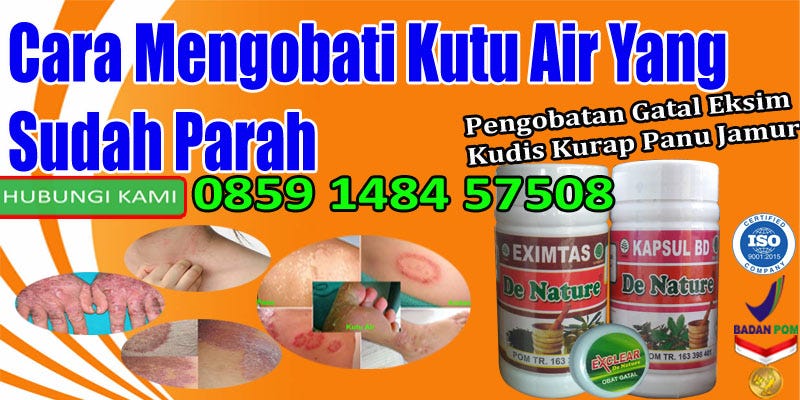 Cara Mengobati Kutu Air Cara Mengobati Kutu Air Yang Sudah Parah | by gatal bae | Medium