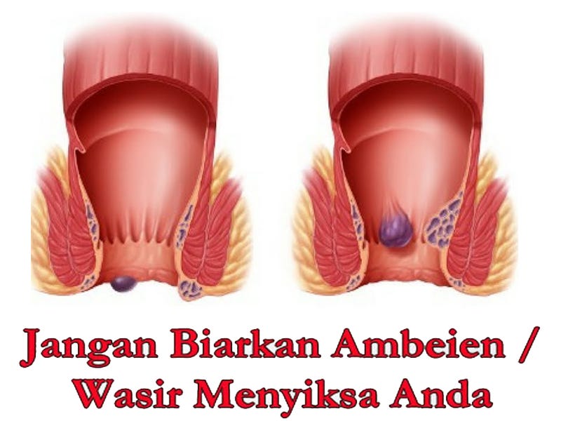 100 Ampuh Cara Mengobati Wasir Atau Ambeien By Obat Ambeien Herbal Medium 100 Ampuh Cara Mengobati Wasir Atau Ambeien By Obat Ambeien Herbal Medium