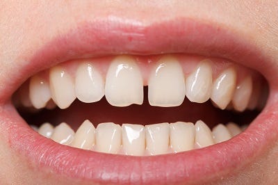 Do Retainers Help To Close Teeth Gaps? | by Robert Rudman | Medium