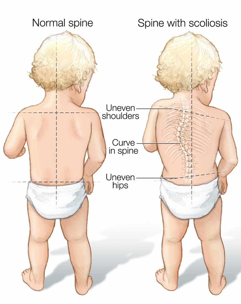 Are Children More Prone To Scoliosis By Logintohealth Medium