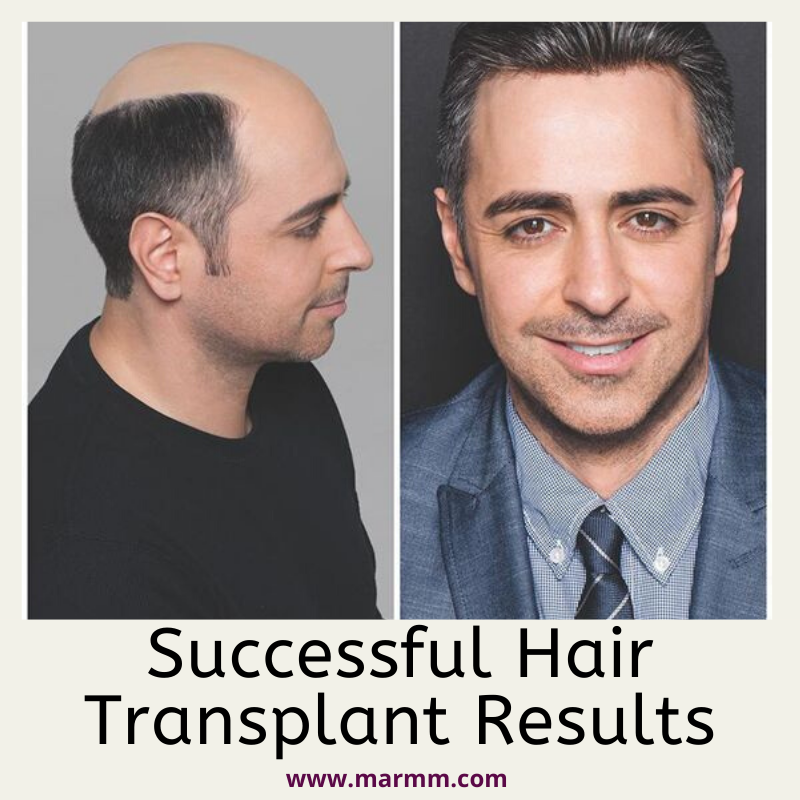 What Points Should be Considered for Successful Hair Transplant Results ...