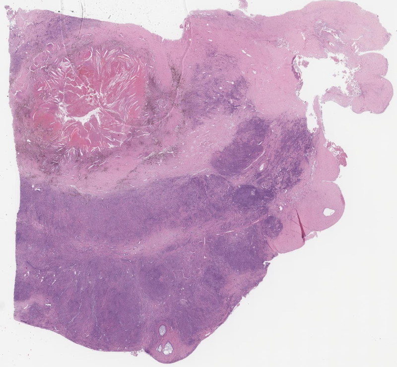 Primary Diffuse Large B-Cell Lymphoma Of The Ovary Arising From ...