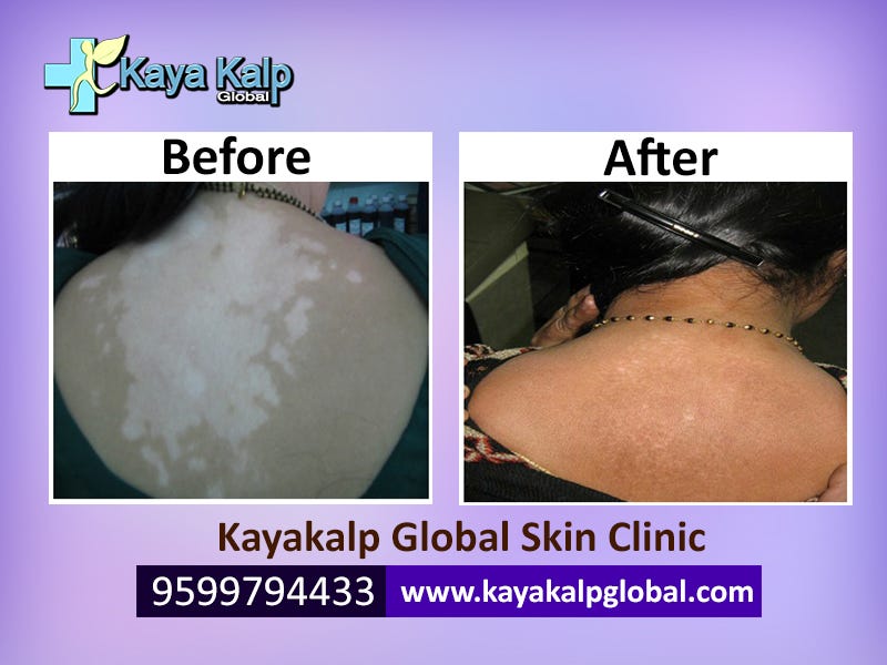 best vitiligo treatment in world