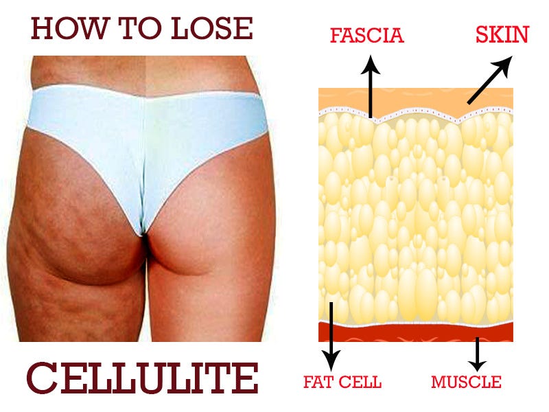 Get Rid Of Cellulite On Legs And Bum Outlet Online, UP TO 69% OFF |  www.aramanatural.es