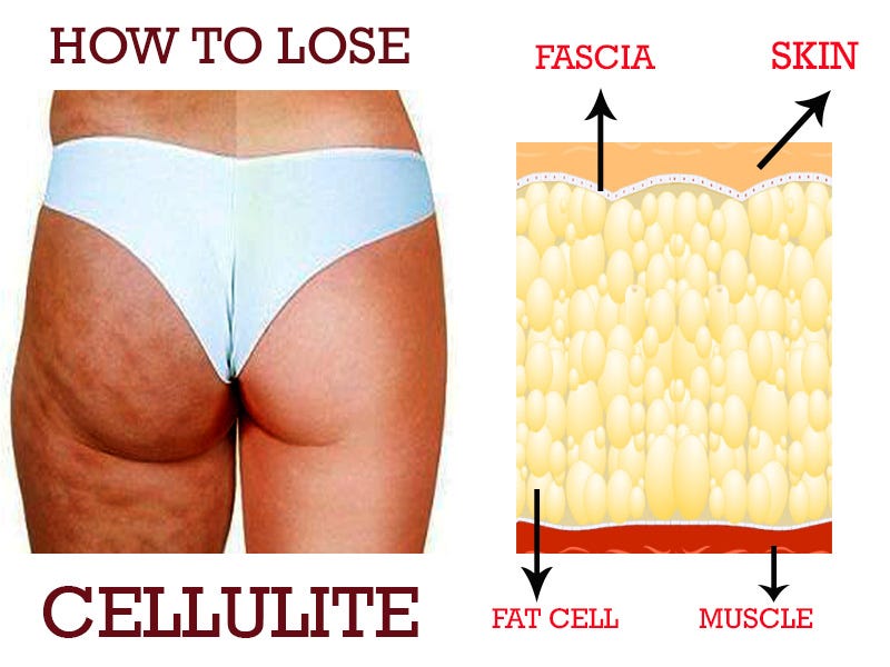 how to get rid of cellulite