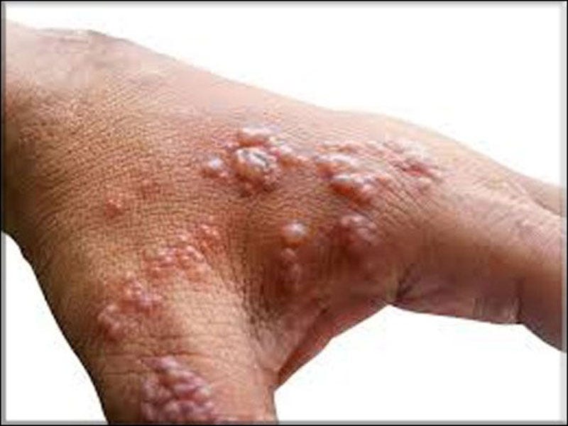 Berapa Lama Herpes Di Bibir Sembuh Herpes Indonesia Medium