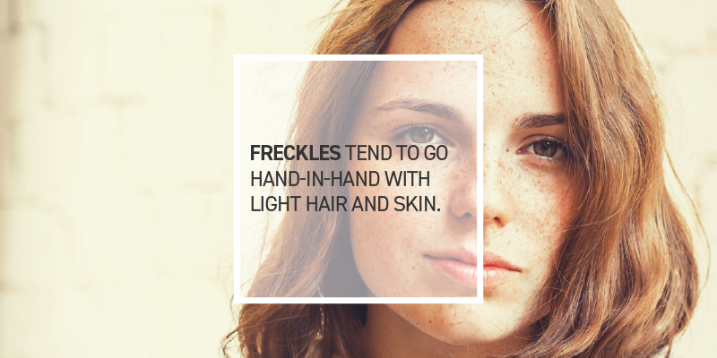 Freckles Can Be Cute but Dangerous