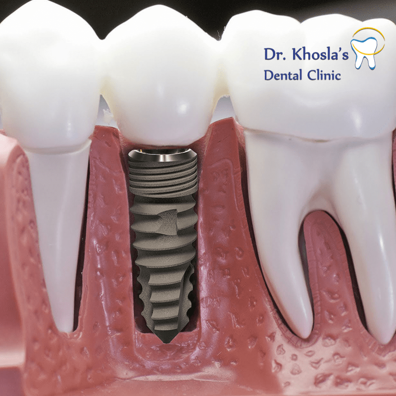 Do You Need A Root Canal Have You Been Facing Problems With Your By Dr Khosla S Dental Clinic Medium