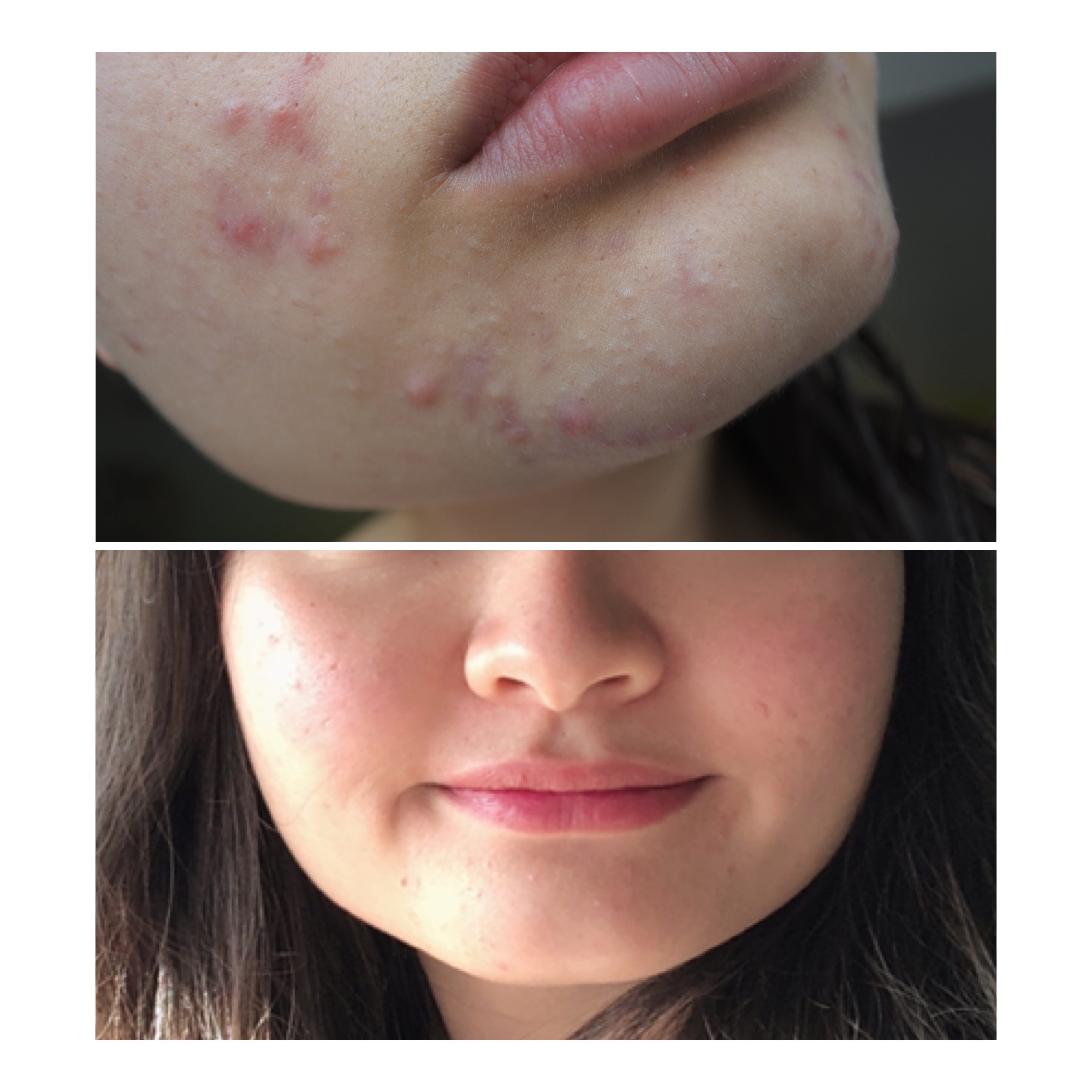 adult acne products