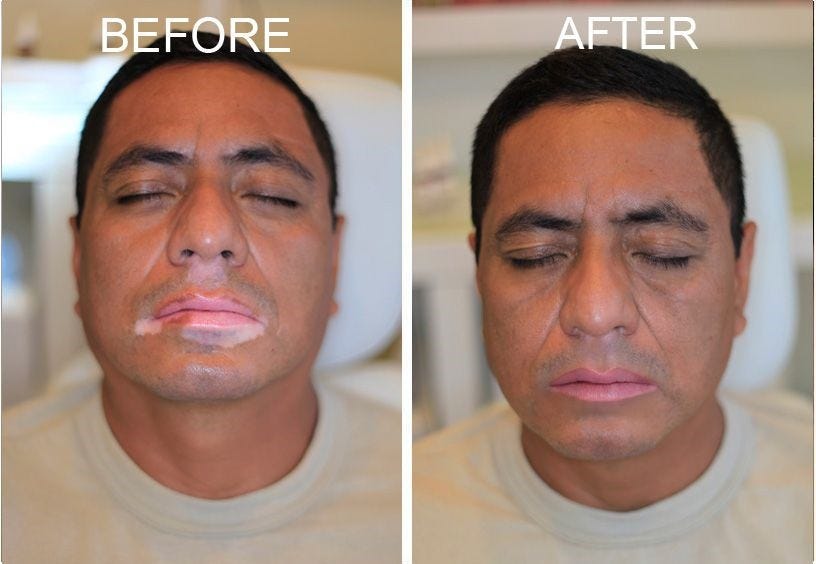 Training For Scar Camouflage Treatment In Fia Academy By Fia Academy Medium