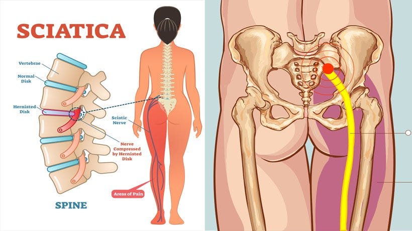 How To Treat Your Sciatica Pain In Lower Back Naturally By Blog Decor Medium